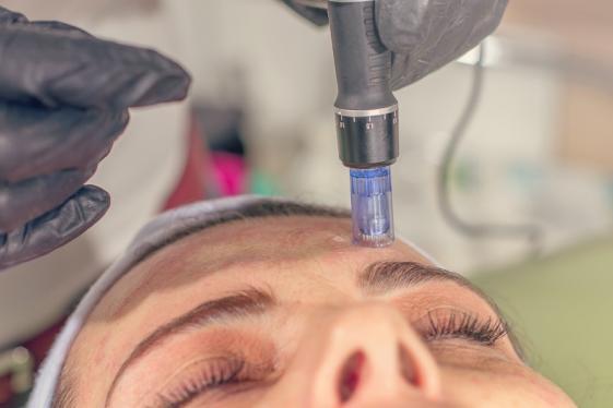 Séance de microneedling